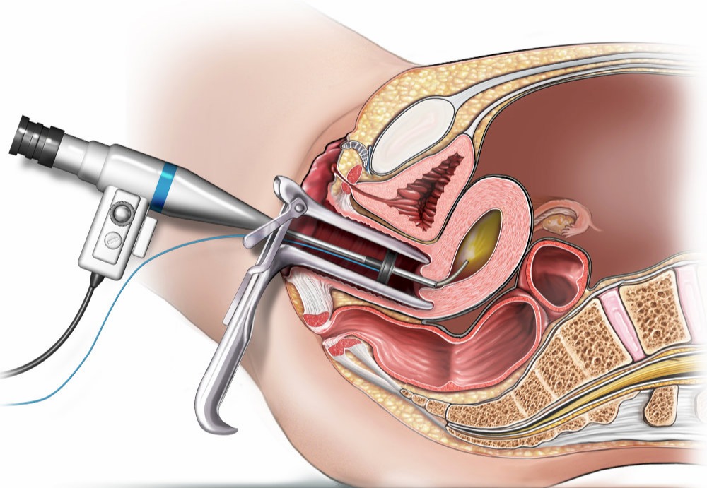 Diagnostic Laparoscopy with Chromopertubation